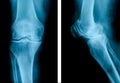 Advanced osteoarthritis