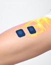 Advanced TENS Unit Therapy on Arm Royalty Free Stock Photo