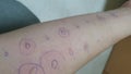 Aeroallergen test rash reaction skin prick test of mite pollen cat and dog allergy