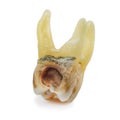 affected by caries, destroyed with a large cavity, removed human tooth with large roots, chewing molar tooth, wisdom tooth, tooth Royalty Free Stock Photo