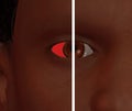 African Female Brown Eye - One Sclera Red - One Sclera White