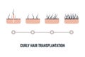 Afro-textured curly hair transplantation surgery result infographics