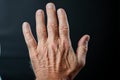 Age related hand discomfort troubles an elderly gentleman