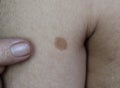 Age spot or nevus on arm. They are brown, gray, or black spots and called liver spots, senile lentigo, solar lentigines, or sun