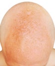 Age spots on the bald head of a man from sunburn Royalty Free Stock Photo