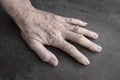 Age spots on hand. They are brown, gray, or black spots and also called liver spots, senile lentigo, solar lentigines, or sun