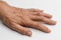 Age spots on hand of Asian elder man. They are brown, gray, or black spots and also called liver spots, senile lentigo, solar