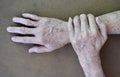 Age spots on hands of Asian elder man. They are brown, gray, or black spots and also called liver spots, senile lentigo, solar