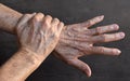 Age spots on hands. They are brown, gray, or black spots and also called liver spots, senile lentigo, solar lentigines, or sun