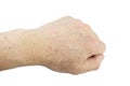 Age spots on hands of man. Liver spots, Brown, black or sun spots