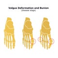 Age and valgus deformity of the thumb. Bunion. Stages of development of the disease. Silhouette of the foot bones. Vector