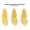 Age and valgus deformity of the thumb. Bunion. Stages of development of the disease. Silhouette of the foot bones. Vector