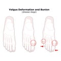 Age and valgus deformity of the thumb. Bunion. Stages of development of the disease. Silhouette of the foot bones. Vector