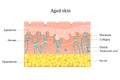 Aged skin layer. Human skin structure with collagen and elastane fibers, hyaluronic acids, fibroblasts. Schematic