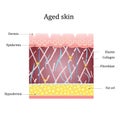 Aged skin layer. Structure human aged skin with collagen and elastin fibers, fibroblasts. Vector diagram Royalty Free Stock Photo