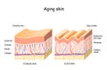 Aging skin. collagen elastin and Oxytalan fibers. Hyaluronic acid