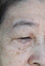 Aging skin folds or skin creases or wrinkles and aging spots at face especially around eye of Southeast Asian, Chinese elderly