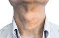 Aging skin folds or skin creases or wrinkles at neck of Asian, Chinese old man