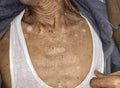 Aging spots called liver spots, nevi and white patches on the chest