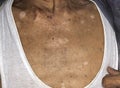 Aging spots called liver spots, nevi and white patches on the chest