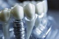 AI generated illustration of nanomaterial coatings on dental implants