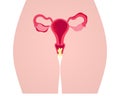 AI generated illustration of a woman's uterus with vaginosis disease