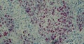 AIDS Mycobacteria tissue