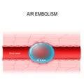 Air embolism is a blood vessel blockage. vector diagram Royalty Free Stock Photo