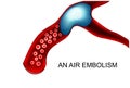 Air embolism is a blood vessel Royalty Free Stock Photo