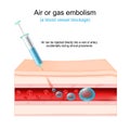Air or gas embolism. blood vessel blockage