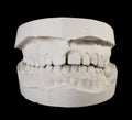Alabaster cast jaws man Royalty Free Stock Photo