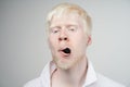 Albinism albino man in studio dressed t-shirt isolated on a white background. abnormal deviations. unusual appearance