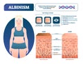 Albinism vector illustration. Labeled medical melanin pigment loss scheme.