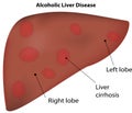 Alcoholic Liver Disease