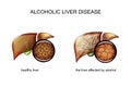 Alcoholic liver disease