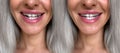 Alignment and correction of tooth defects Royalty Free Stock Photo