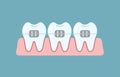 Alignment of bite of teeth, dental row with braces, Orthodontic, stomatology concept.