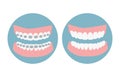 Before and after alignment teeth process. Alignment of bite of teeth, dental row with braces