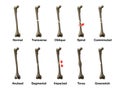 All Types of Bone Fractures Royalty Free Stock Photo