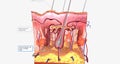 All types of EDS are caused by inherited, genetic abnormalities that affect the different genes responsible for collagen formation
