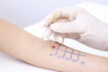 Allergen test on hand. child undergoing procedure of allergen skin test