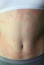 Allergic dermatitis Royalty Free Stock Photo