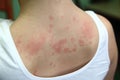 Allergic dermatitis