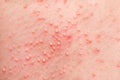 Allergic rash