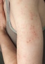 Allergic rash dermatitis Royalty Free Stock Photo