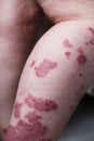 Allergic rash dermatitis eczema skin on leg of patient. Psoriasis and eczema skin with big red spots Royalty Free Stock Photo