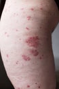 Allergic rash dermatitis eczema skin on leg of patient. Psoriasis and eczema skin with big red spots Royalty Free Stock Photo