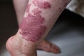 Allergic rash dermatitis eczema skin on leg of patient. Psoriasis and eczema skin with big red spots Royalty Free Stock Photo