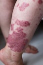 Allergic rash dermatitis eczema skin on leg of patient. Psoriasis and eczema skin with big red spots