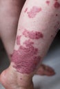 Allergic rash dermatitis eczema skin on leg of patient. Psoriasis and eczema skin with big red spots Royalty Free Stock Photo